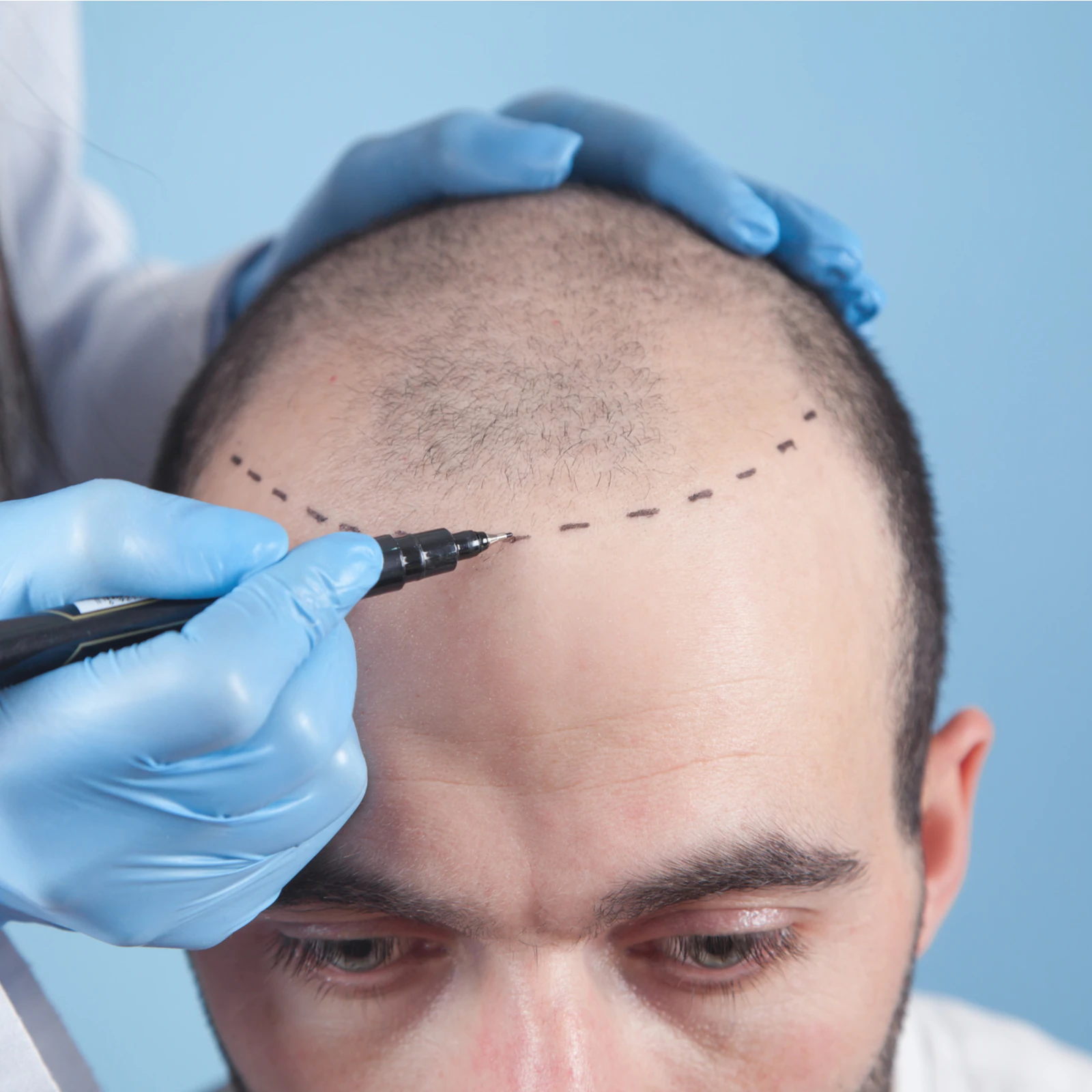 hair transplant