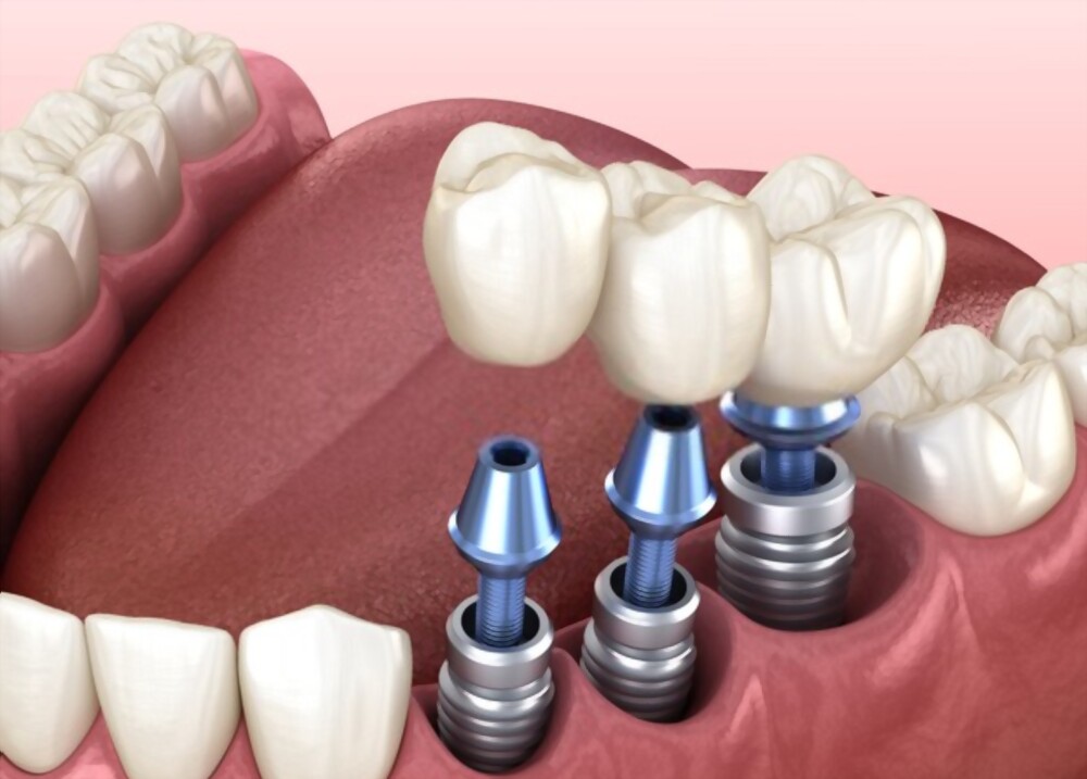 Dental Implants