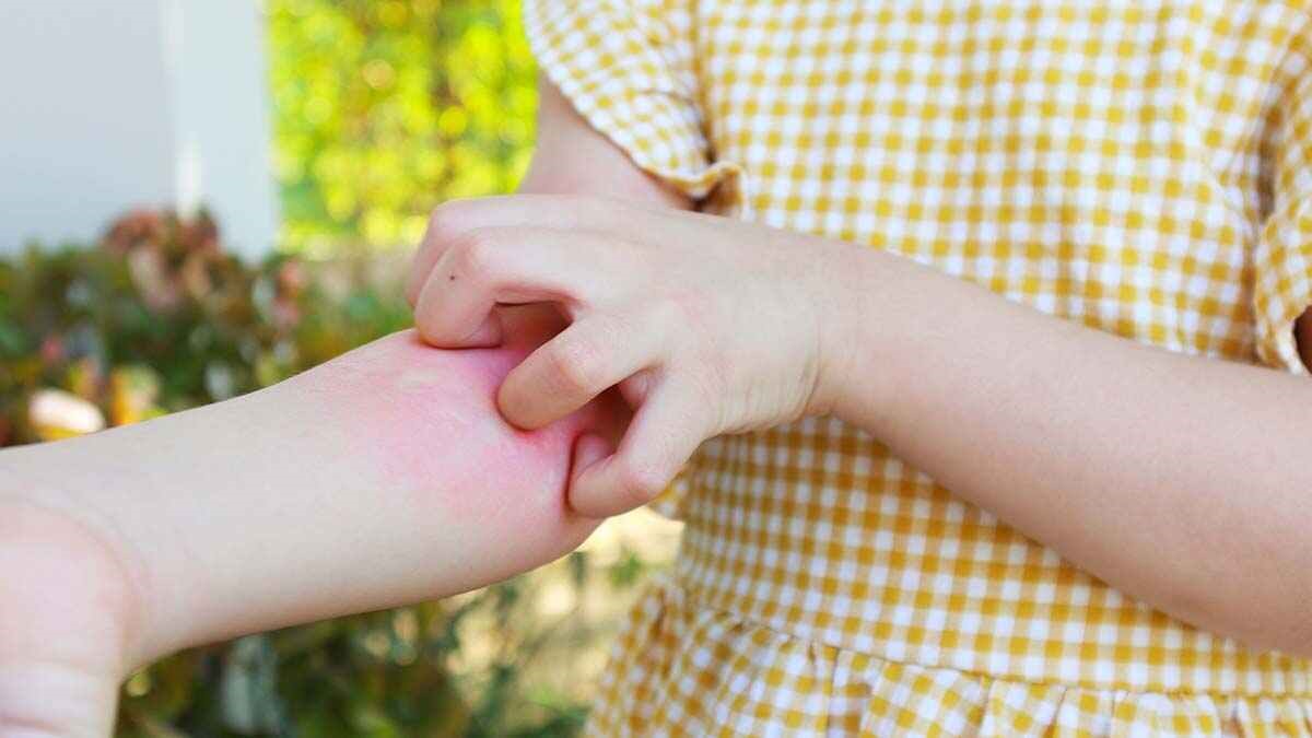 Scabies Treatments