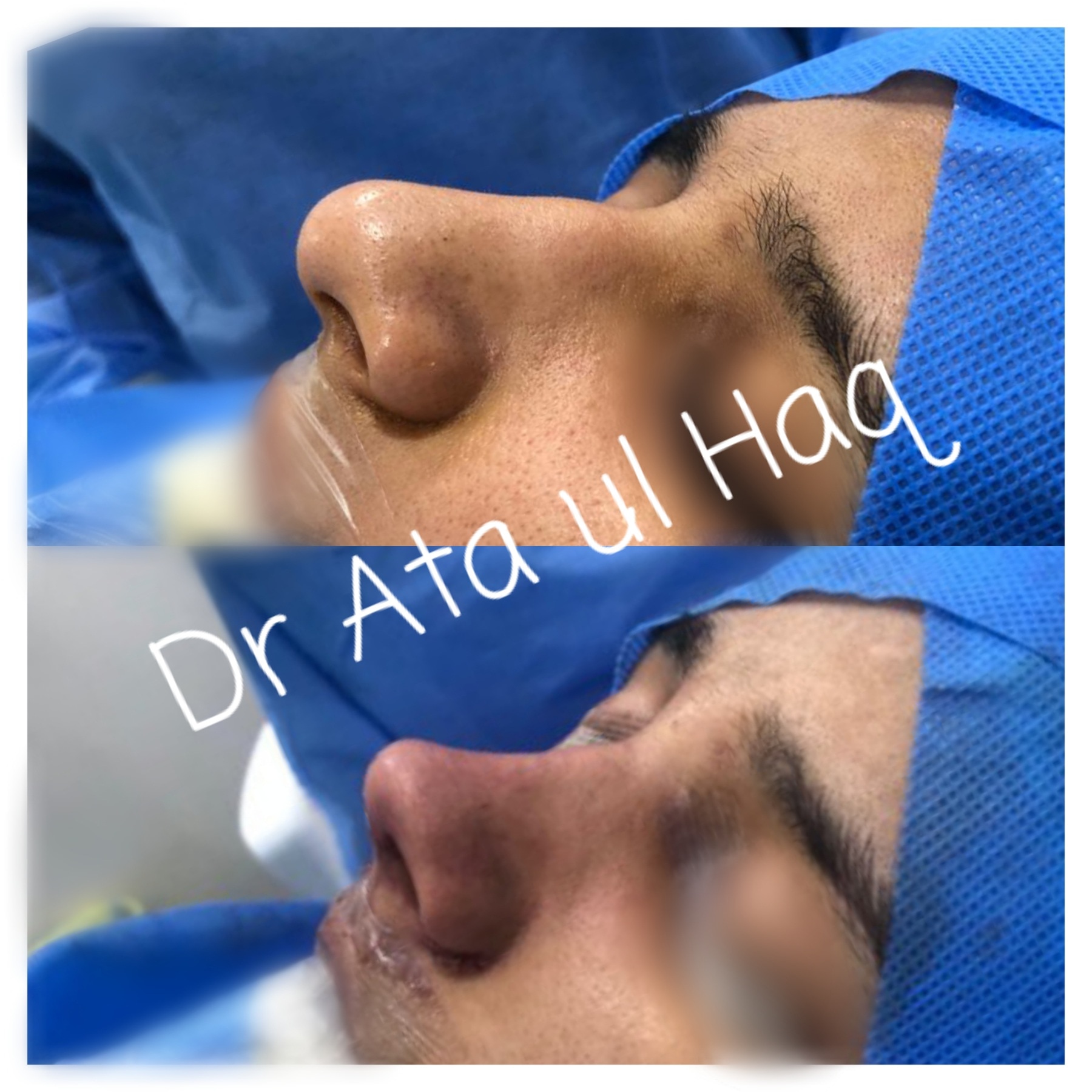 Rhinoplasty in lahore pakistan